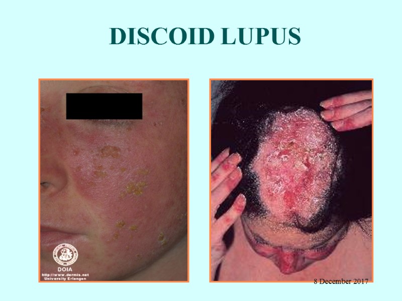 DISCOID LUPUS 8 December 2017